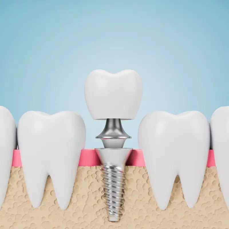 Grafika implanta zęba