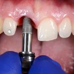 zabieg wszczepienia implantu zębowego