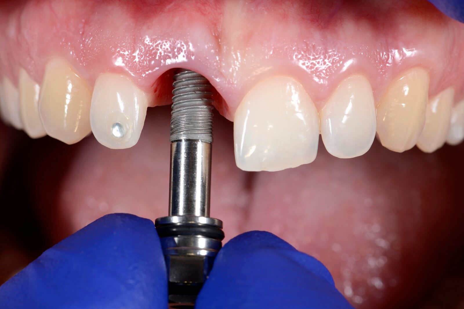 zabieg wszczepienia implantu zębowego