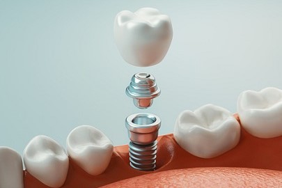 implant stomatologiczny