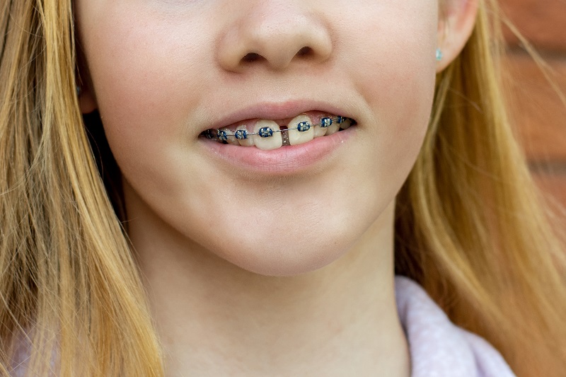 dziewczynka z diastemą nosząca aparat ortodontyczny