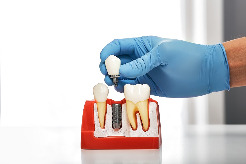 dentysta pokazujący instalację implantu dentystycznego